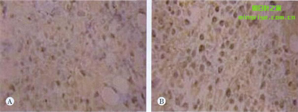 圖2肝癌細胞Bax蛋白的表達(DAB x 400). A：陰性對照組；B：AC 40 mg/kg組