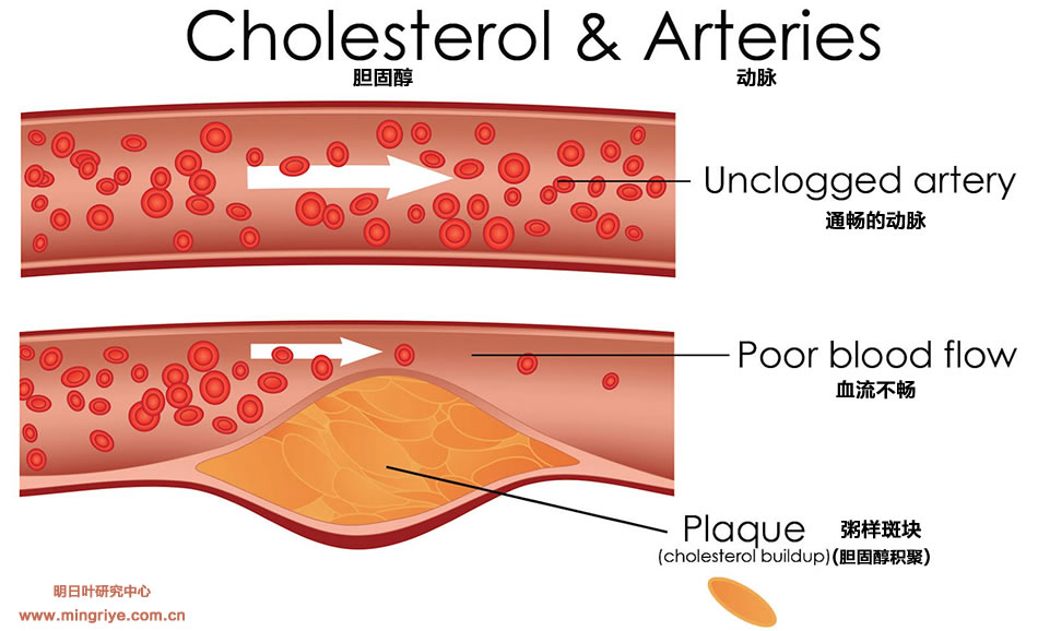 高膽固醇與動脈 cholesterol-Levels-arteries